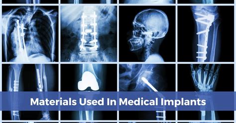  Zetanium: revolutionair materiaal voor medische implantaten en hoogwaardige kunststoffen!